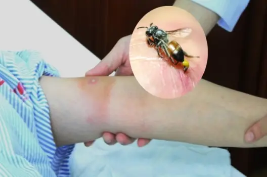 Bị ong đốt có sao không? Cách xử lý nhanh và hiệu quả
