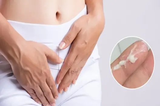 Bị ra huyết trắng nhiều có sao không và cách khắc phục