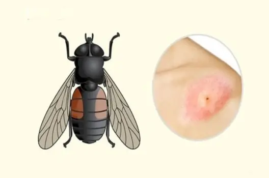 Bị ruồi cắn có sao không và cách xử lý nhanh chóng