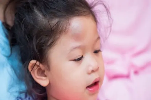 Bị u đầu có sao không dấu hiệu nguy hiểm cần lưu ý