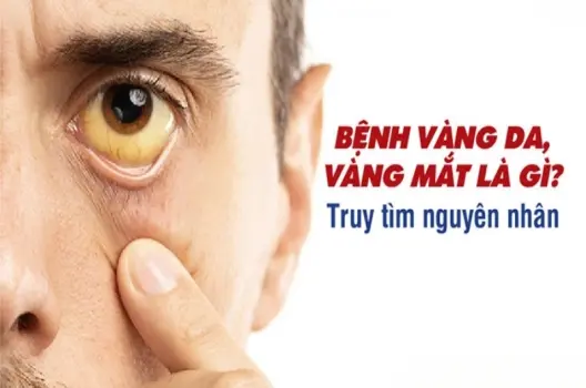 Bị vàng mắt có sao không? Nguyên nhân và cách xử lý