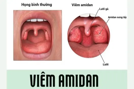 Bị viêm amidan có sao không và cách điều trị hiệu quả