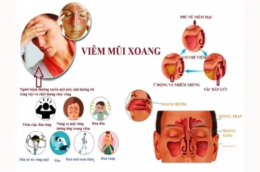 Bị viêm xoang có sao không và cách phòng ngừa hiệu quả