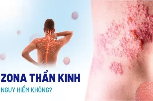 Bị zona có sao không và cách xử lý an toàn