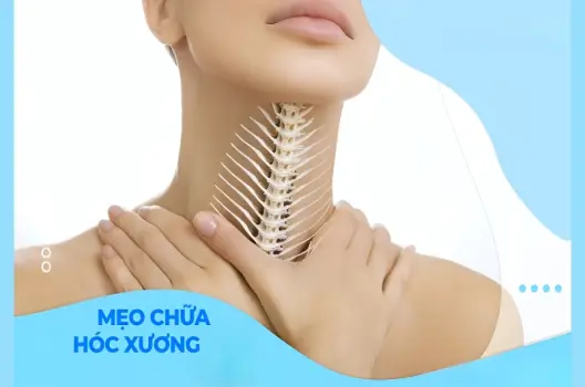 Cách chữa mẹo hóc xương nhanh gọn hiệu quả tại nhà