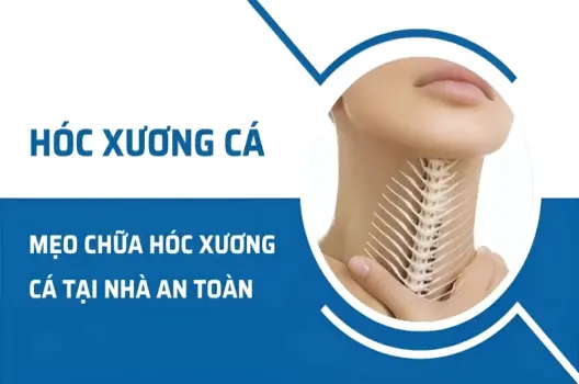 Tổng hợp cách chữa hóc xương cá bằng mẹo dân gian đơn giản