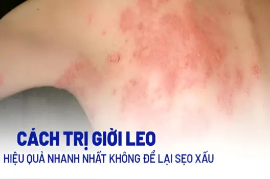 Chia sẻ cách chữa mẹo giời leo đơn giản dễ áp dụng tại nhà