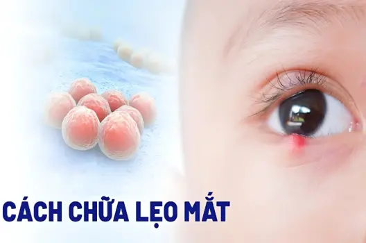 Cách chữa mẹo lên lẹo dân gian được truyền lại nhiều đời