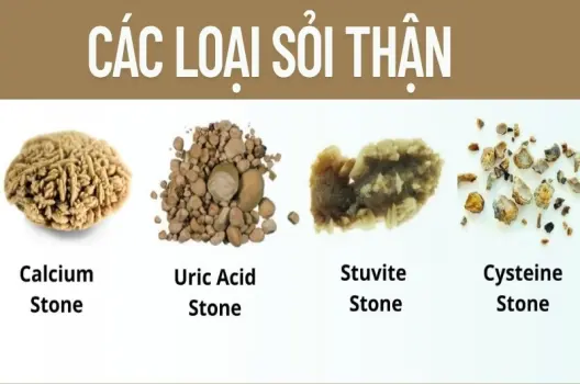 Sỏi thận hình thành như thế nào? Hiểu rõ nguyên nhân để phòng ngừa hiệu quả