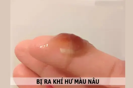 Giải đáp chi tiết: Dịch màu nâu có bị sao không