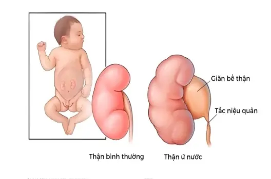 Em bé bị giãn thận có sao không và khi nào cần lo lắng