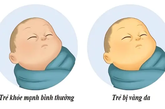 Em bé bị vàng da có sao không cách nhận biết sớm