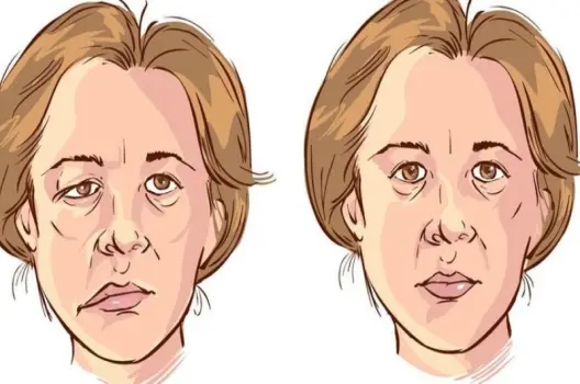 Giật cơ mặt có bị sao không? Nguyên nhân và cách xử lý