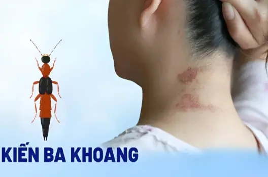Kiến ba khoang cắn có bị sao không và cách xử lý kịp thời