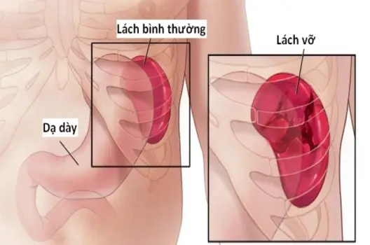 Lá lách to có bị sao không và cách nhận biết sớm