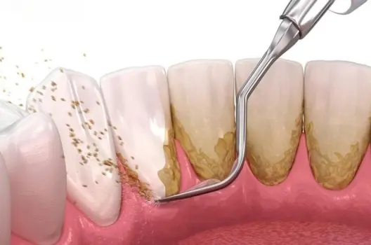 Tìm hiểu lấy cao răng có bị sao không và tác hại tiềm ẩn