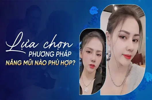 Bật mí 7 mẹo hiệu quả giúp tiết kiệm chi phí nâng mũi