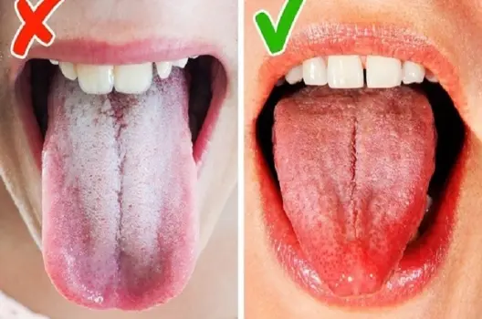Lưỡi màu trắng có bị sao không và cách xử lý kịp thời