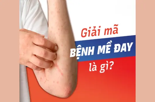 Cách chữa mề đay bằng mẹo siêu đơn giản ai cũng làm được