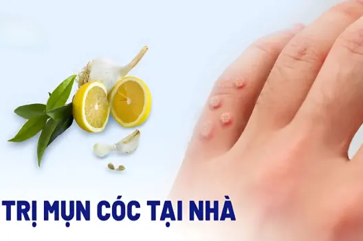 Bí quyết để chữa mẹo mụn cóc nhanh chóng không tái phát