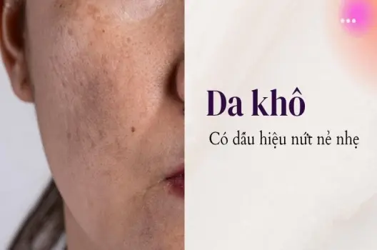 Như thế nào là da khô? Hiểu rõ để cấp ẩm và nuôi dưỡng làn da mịn màng