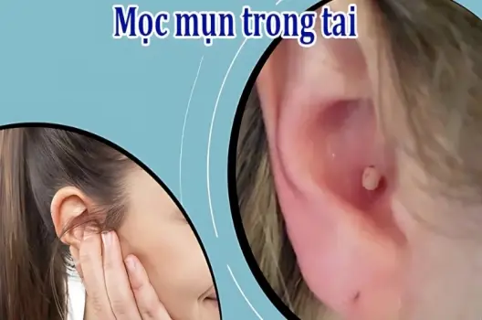 Mụn mọc trong tai có bị sao không và cách xử lý an toàn