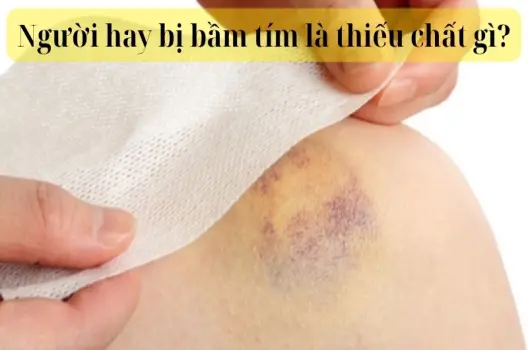 Người hay bị bầm tím là thiếu chất gì trong chế độ ăn