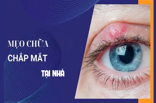 Cách chữa chắp mắt bằng mẹo dân gian đơn giản hiệu quả