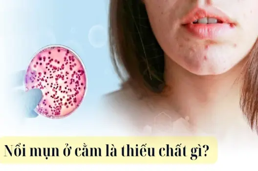 Nổi mụn ở cằm là thiếu chất gì? Cảnh báo từ cơ thể