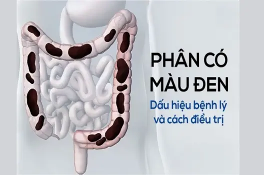 Phân màu đen có bị sao không và cách xử lý tại nhà