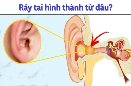 Ráy tai được hình thành như thế nào? Hướng dẫn chăm sóc tai đúng cách