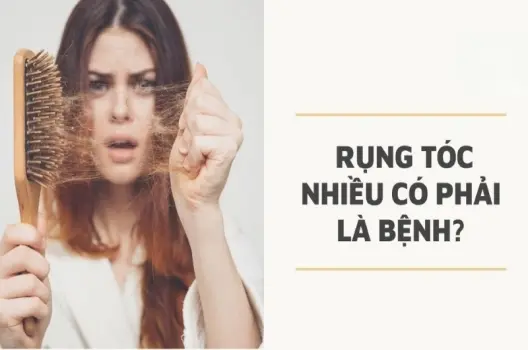 Rụng tóc nhiều có bị sao không? Cảnh báo từ chuyên gia