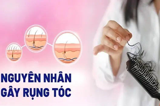 Tóc rụng nhiều có bị sao không và cách xử lý hiệu quả