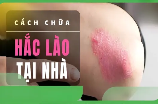 Bật mí cách chữa hắc lào bằng mẹo dân gian tại nhà