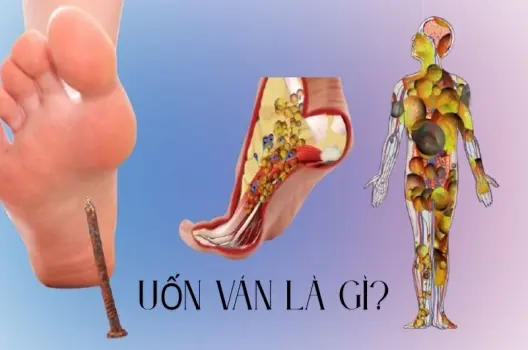 Uốn ván là như thế nào? Hiểu rõ để chủ động phòng ngừa