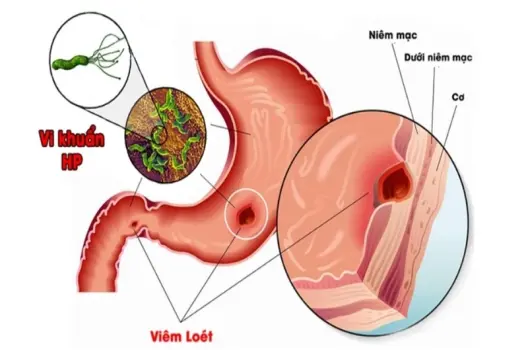 Viêm dạ dày HP có bị sao không và cách điều trị hiệu quả