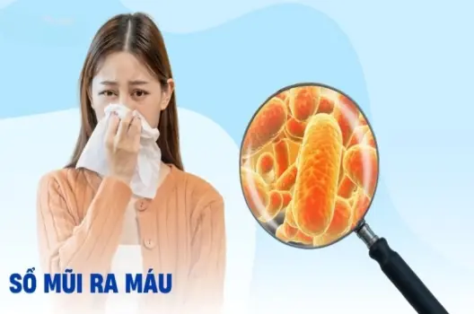 Xì mũi ra máu có bị sao không và khi nào nên đi khám