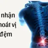 Cách nhận biết thoát vị đĩa đệm qua cơn đau buổi sáng