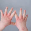 Bé Bị Nổi Mề Đay: Tổng Hợp Mẹo Chữa Trị An Toàn Tại Nhà Cho Trẻ