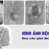 Bệnh trĩ: Nguyên nhân, triệu chứng và cách điều trị hiệu quả