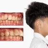 Cằm lẹm là gì? Dấu hiệu, nguyên nhân và cách khắc phục hiệu quả
