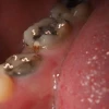 Con sâu răng là gì? Phân biệt với các bệnh lý răng miệng thường gặp