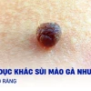 Gai sinh dục: Nguyên nhân, nhận biết và cách xử lý hiệu quả