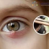 Mẹo chữa lẹo mắt bằng đũa: Hiệu quả hay chỉ là truyền miệng?