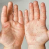Mẹo Dân Gian Chữa Bệnh Chân Tay Miệng Hiệu Quả Cho Trẻ