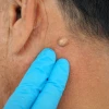 Mẹo dân gian chữa u bã đậu: Liệu có an toàn và hiệu quả?