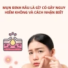 Mụn đầu đinh: Mẹo chữa dân gian hiệu quả và cách phòng tránh tại nhà