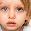 Nốt Thủy Đậu: Nhận Biết, Giai Đoạn Phát Triển và Cách Xử Lý Đúng