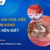 Tác hại của việc trám răng: Nhận diện và cách phòng ngừa hiệu quả