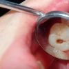 Tác hại khôn lường khi không nhổ răng sâu